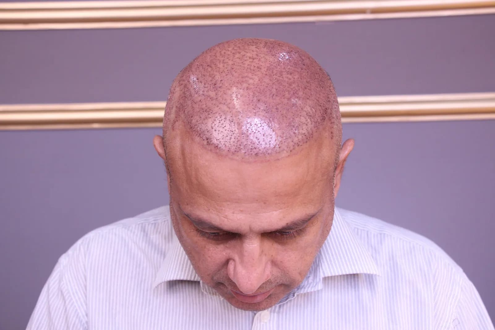 Hair Transplant – Discover the Latest Techniques &amp; Technology