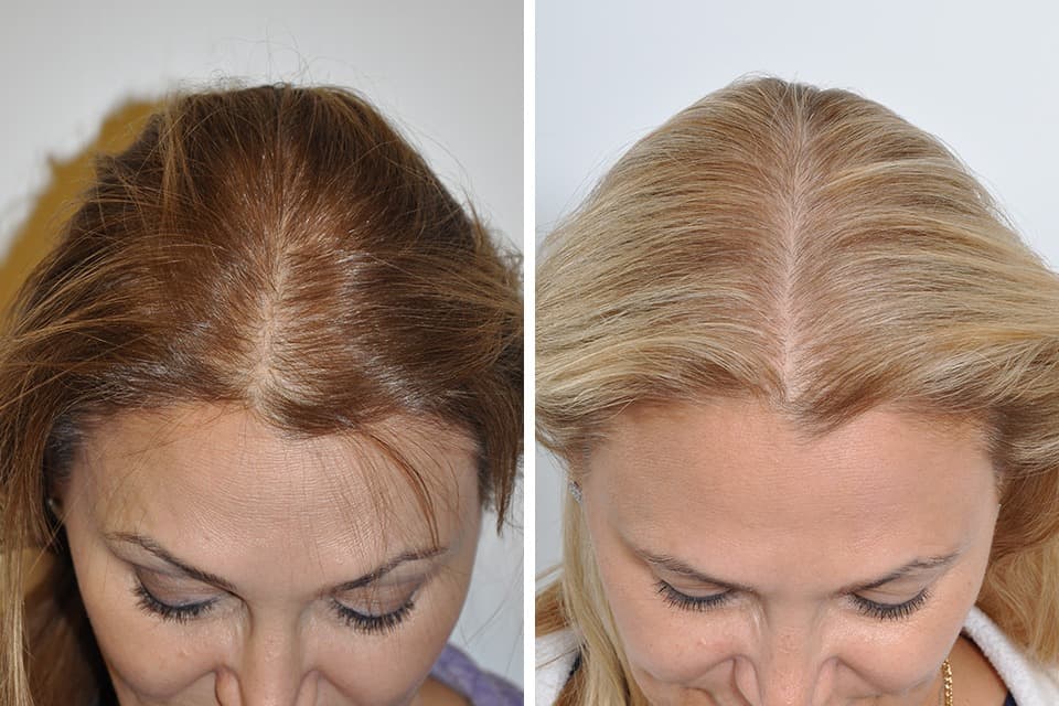 Hair Transplant Turkey: The Ultimate 2025 Price Breakdown