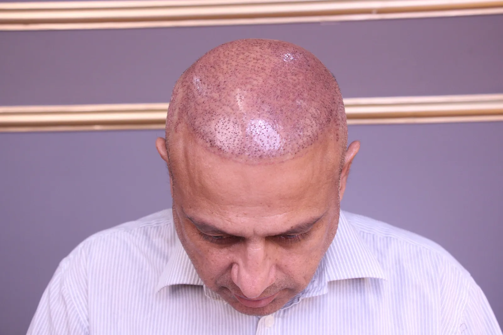 Hair Transplant – Discover the Latest Techniques & Technology