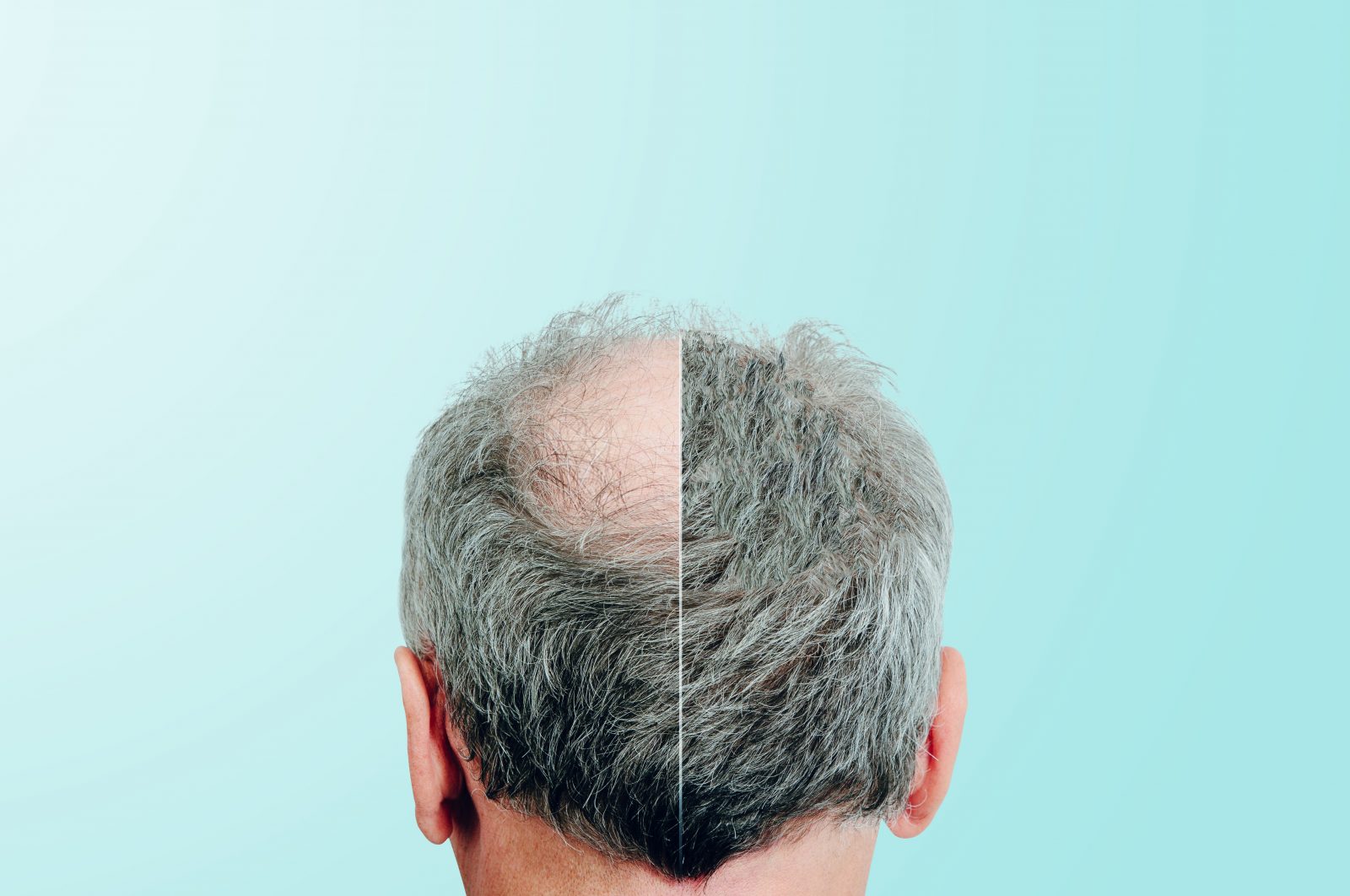 Natural-Looking Hair Transplant UK Results You’ll Love